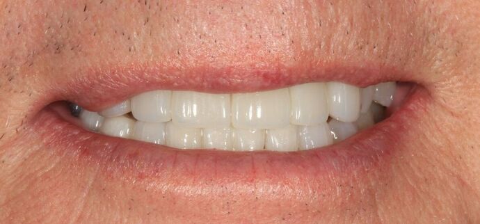 Invisalign Case 23 - After