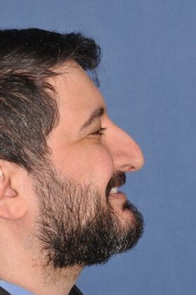 Rhinoplasty Big bump, tension nose - Before