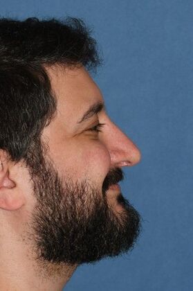 Rhinoplasty Big bump, tension nose - After