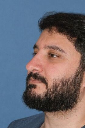 Rhinoplasty: Big bump, tension nose - After