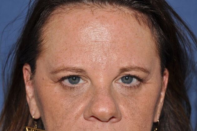 Endoscopic Browlift: Brow and Lids and her vision prescription got better! - Before