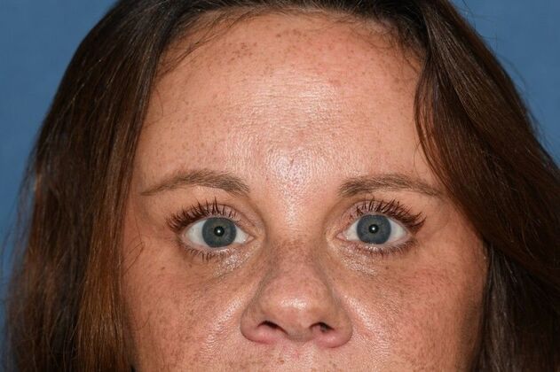 Endoscopic Browlift: Brow and Lids and her vision prescription got better! - After