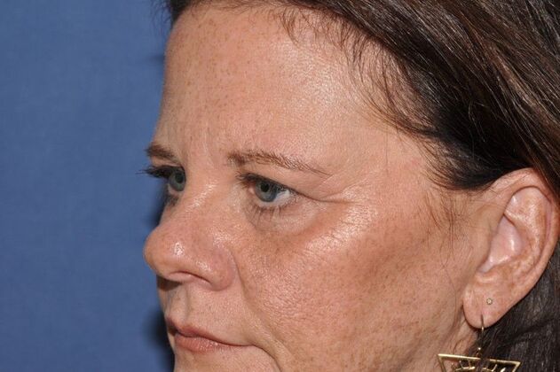 Endoscopic Browlift Brow and Lids and her vision prescription got better! - Before