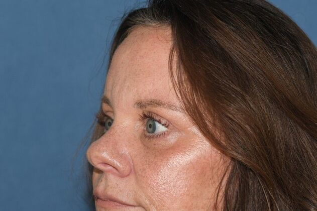 Endoscopic Browlift Brow and Lids and her vision prescription got better! - After