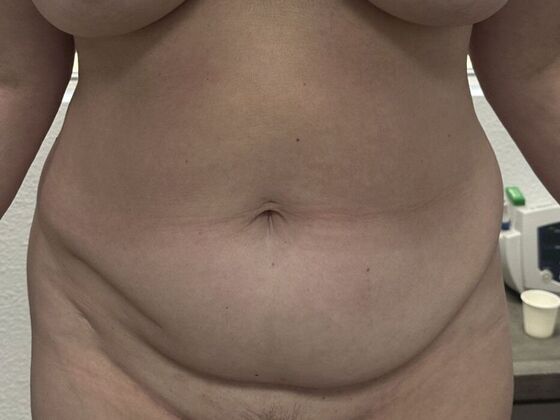 Tummy Tuck (Abdominoplasty): Case 604 - Before