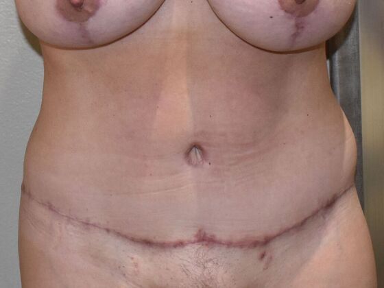 Tummy Tuck (Abdominoplasty): Case 604 - After