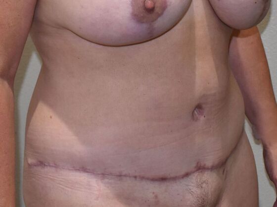 Tummy Tuck (Abdominoplasty): Case 604 - After