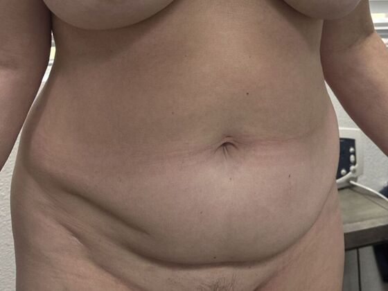 Tummy Tuck (Abdominoplasty): Case 604 - Before