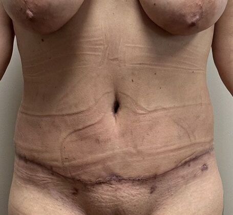 Massive Weight Loss  Case 226 - After