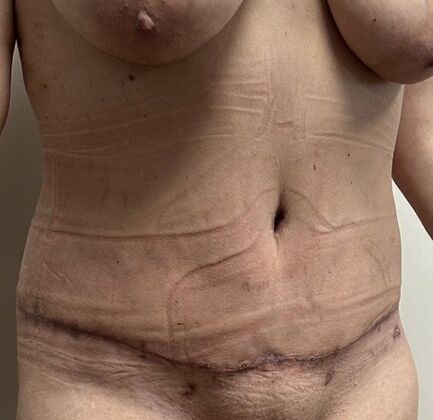 Massive Weight Loss : Case 226 - After