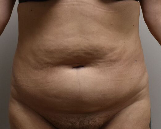 Massive Weight Loss  Case 226 - Before