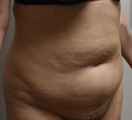 Massive Weight Loss : Case 226 - Before