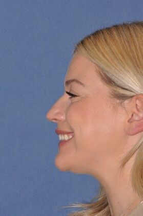 Rhinoplasty Small bump, tip rotation - Before