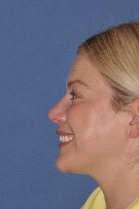 Rhinoplasty Small bump, tip rotation - After