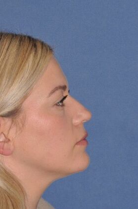 Rhinoplasty: Small bump, tip rotation - Before
