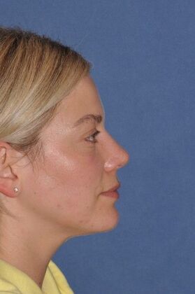 Rhinoplasty: Small bump, tip rotation - After