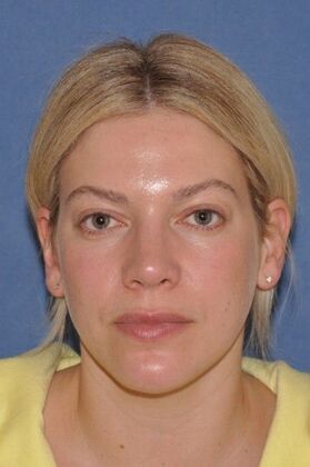Rhinoplasty: Small bump, tip rotation - After