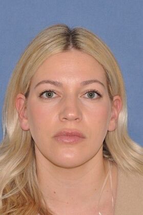 Rhinoplasty: Small bump, tip rotation - Before