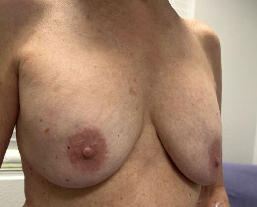 Breast Revision: Case 355 - Before