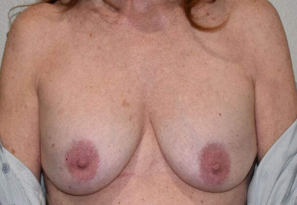 Breast Revision Case 355 - Before