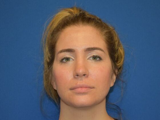 Facial Rejuvenation: FaceTite with Submental Lipo - Before