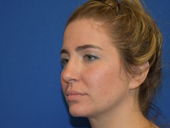 Facial Rejuvenation: FaceTite with Submental Lipo - Before