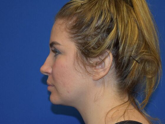 Facial Rejuvenation FaceTite with Submental Lipo - Before