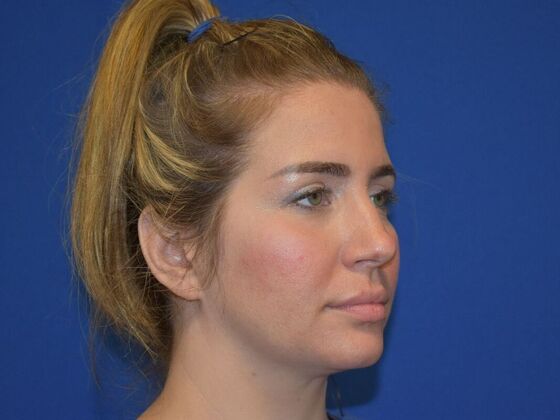 Facial Rejuvenation: FaceTite with Submental Lipo - Before