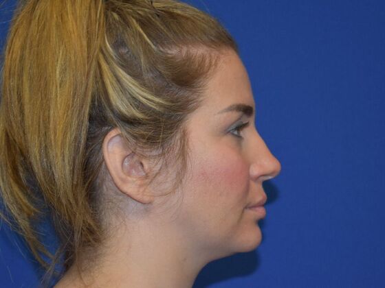 Facial Rejuvenation: FaceTite with Submental Lipo - Before