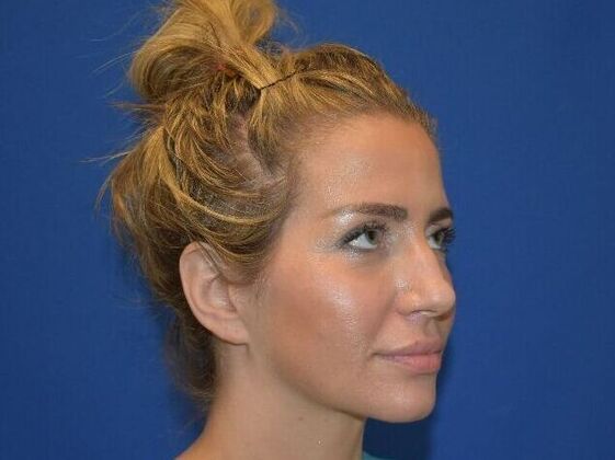 Facial Rejuvenation: FaceTite with Submental Lipo - After