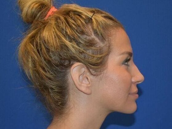 Facial Rejuvenation: FaceTite with Submental Lipo - After