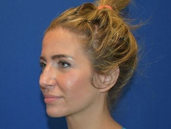 Facial Rejuvenation: FaceTite with Submental Lipo - After