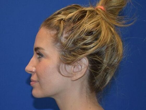 Facial Rejuvenation FaceTite with Submental Lipo - After