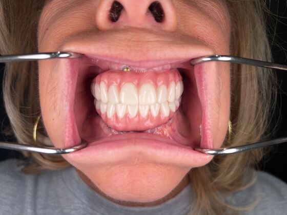 All on 4 Dental Implants: Case 17 - After