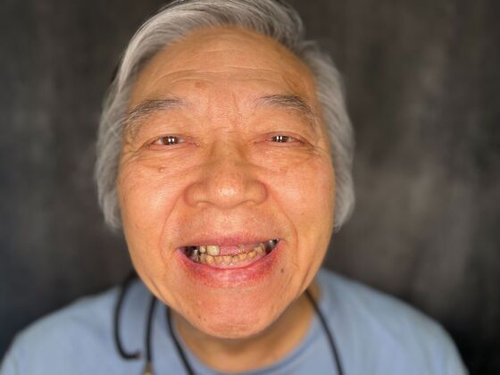 All on 4 Dental Implants: Case 22 - Before