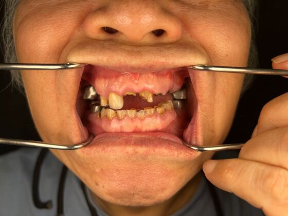 All on 4 Dental Implants: Case 22 - Before