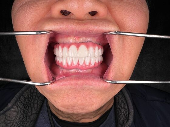 All on 4 Dental Implants: Case 22 - After