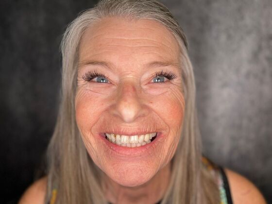 All on 4 Dental Implants: Case 23 - Before