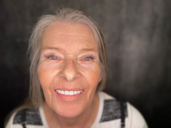 All on 4 Dental Implants: Case 23 - After