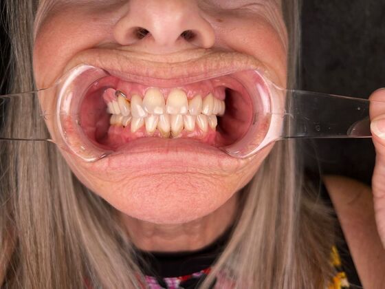 All on 4 Dental Implants: Case 23 - Before