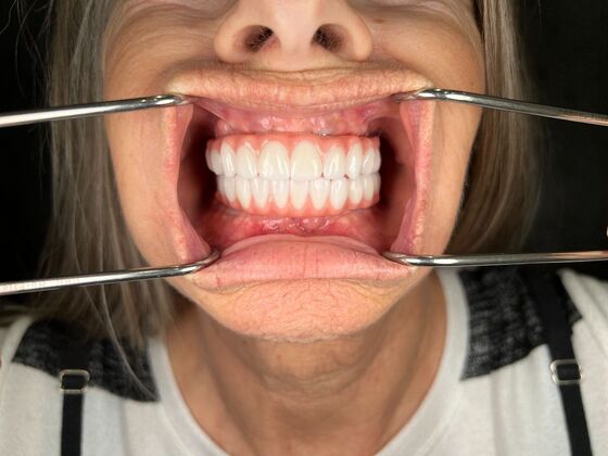 All on 4 Dental Implants: Case 23 - After
