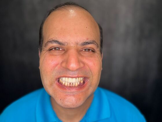 All on 4 Dental Implants: Case 24 - Before