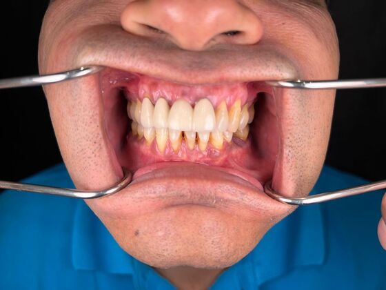 All on 4 Dental Implants: Case 24 - Before