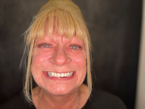 All on 4 Dental Implants: Case 25 - Before