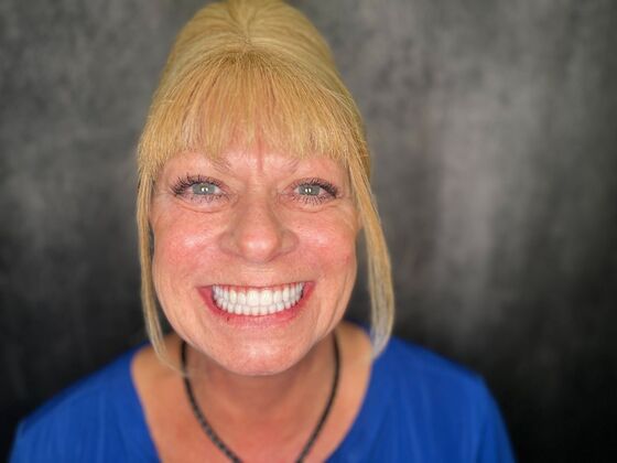 All on 4 Dental Implants: Case 25 - After