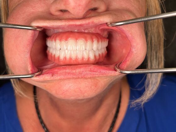 All on 4 Dental Implants: Case 25 - After