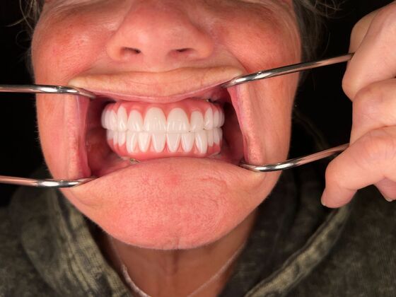 All on 4 Dental Implants: Case 26 - After