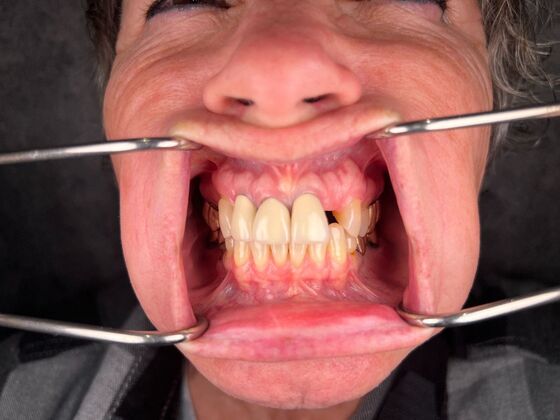 All on 4 Dental Implants: Case 26 - Before