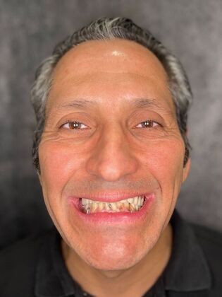 All on 4 Dental Implants: Case 27 - After