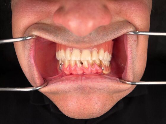 All on 4 Dental Implants: Case 27 - Before